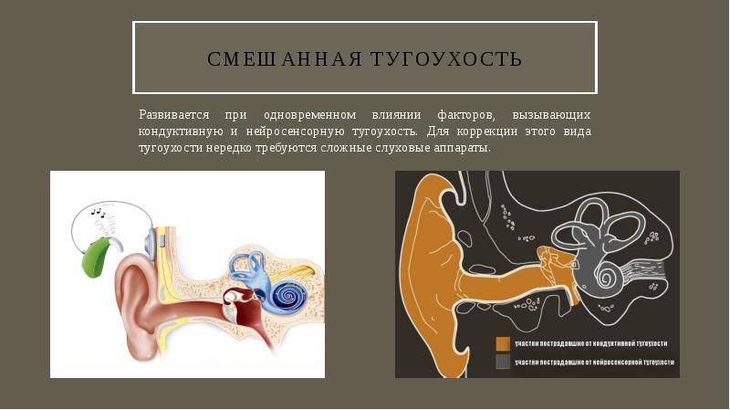 Категория годности при тугоухости, особенности призыва