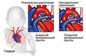 Забирают ли в армию с пороком сердца?