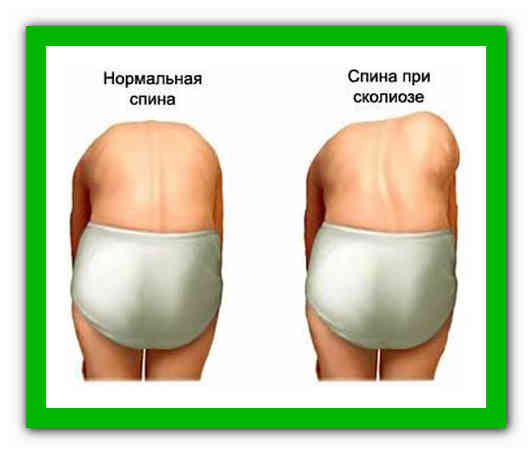 Берут ли в армию со сколиозом 1, 2, 3, 4 степени  и как подтвердить диагноз