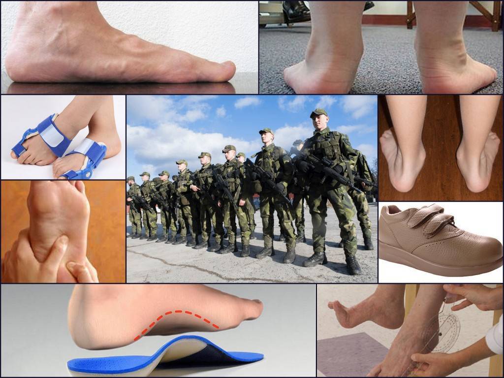 Возьмут ли на службу в армию призывников с грибком ног (микозом)